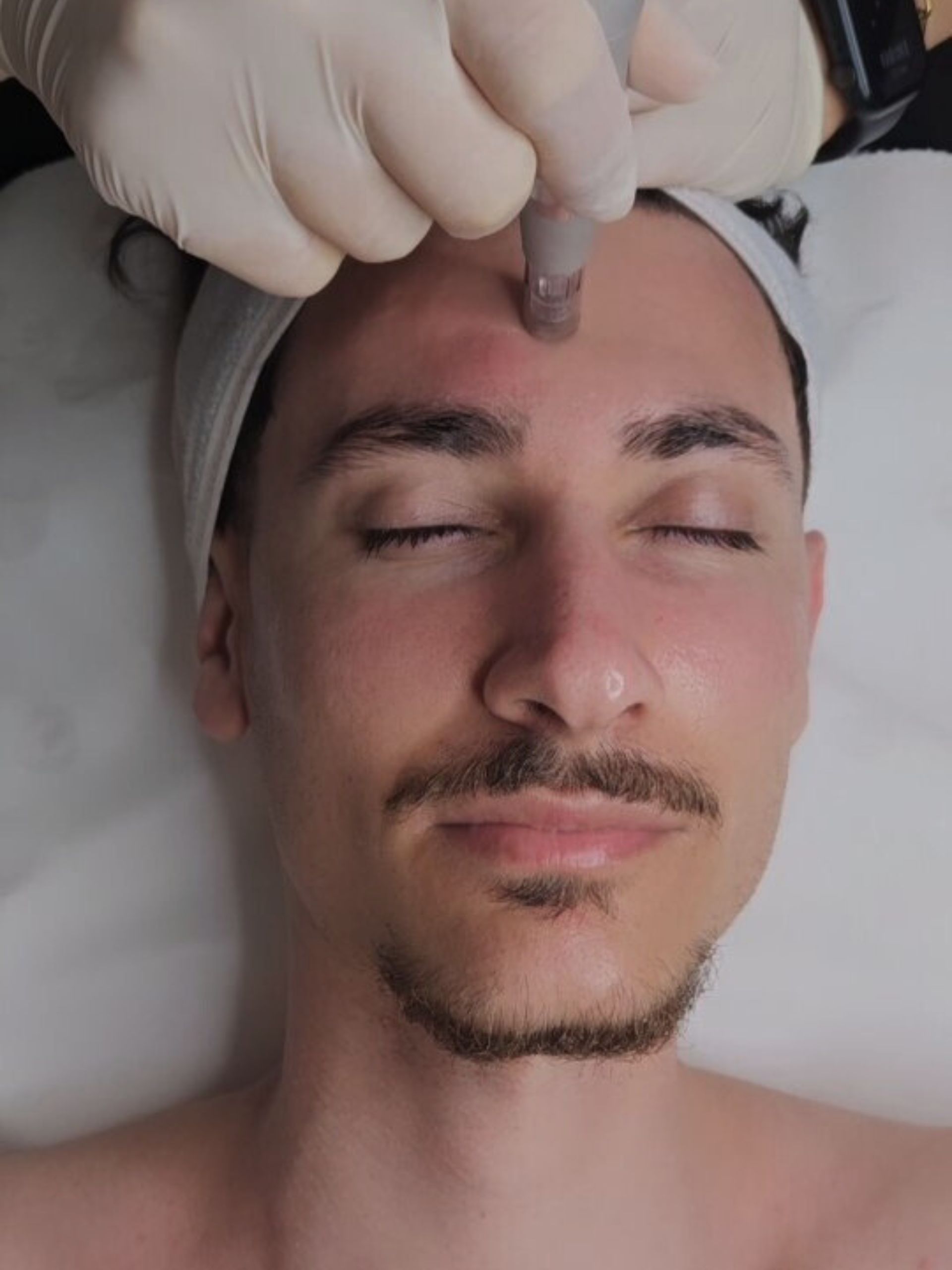 Microneedling Hamburg